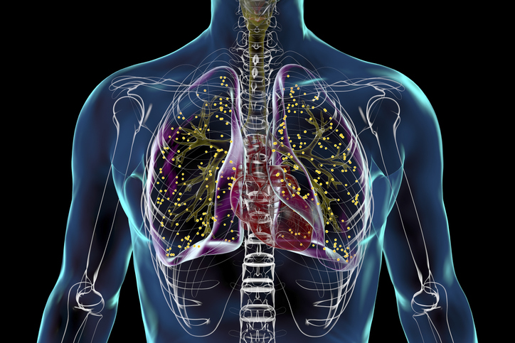 Graphic depicting TB infection of the lungs